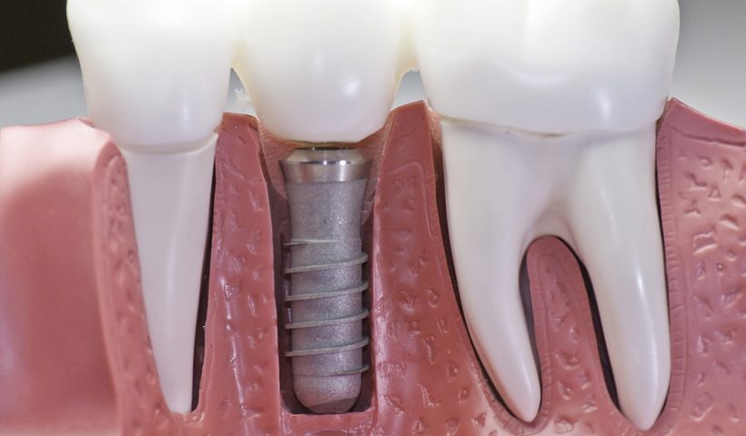 all on 8 dental implants