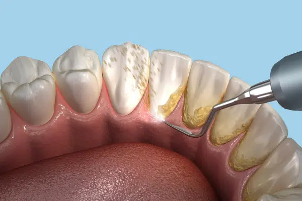 Dental cleaning los angeles