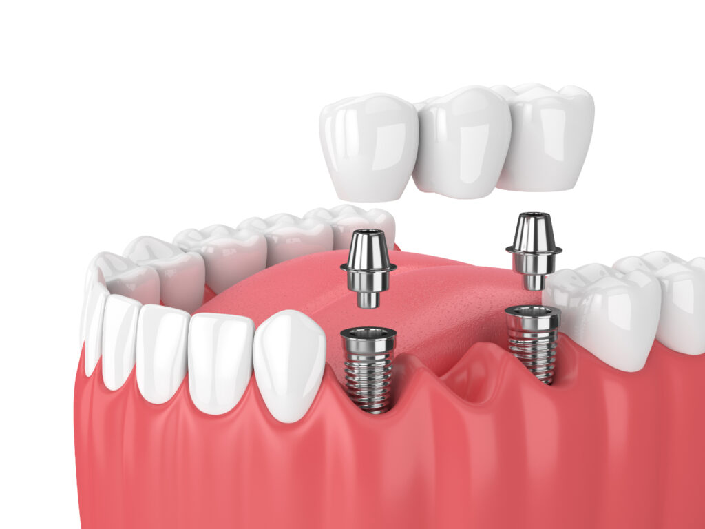 Dental implants in Encino